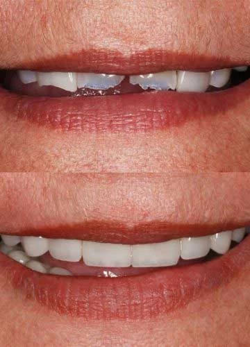 restored smile