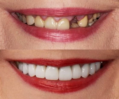 Best Tooth decay Prevention Wausau