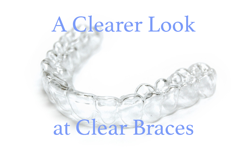 A Clearer Look At Clear Braces