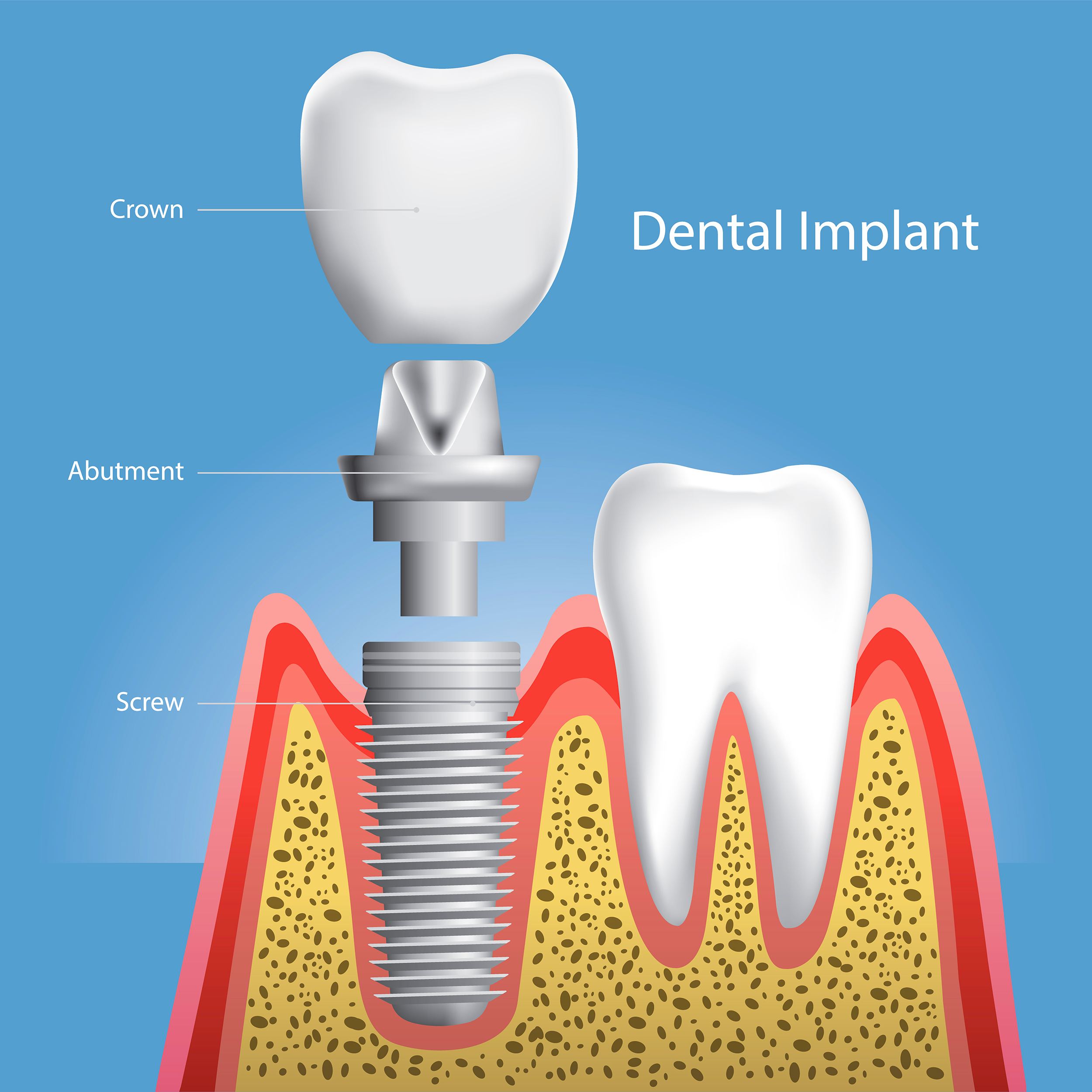 Implant Dentistry Landing Page