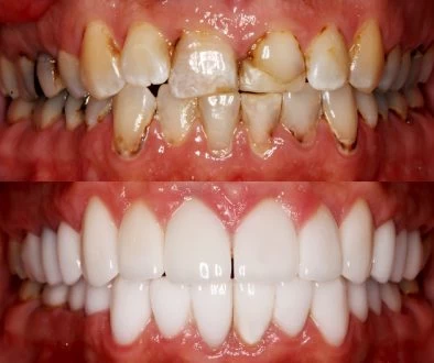Tobacco Effects on Teeth Wausau