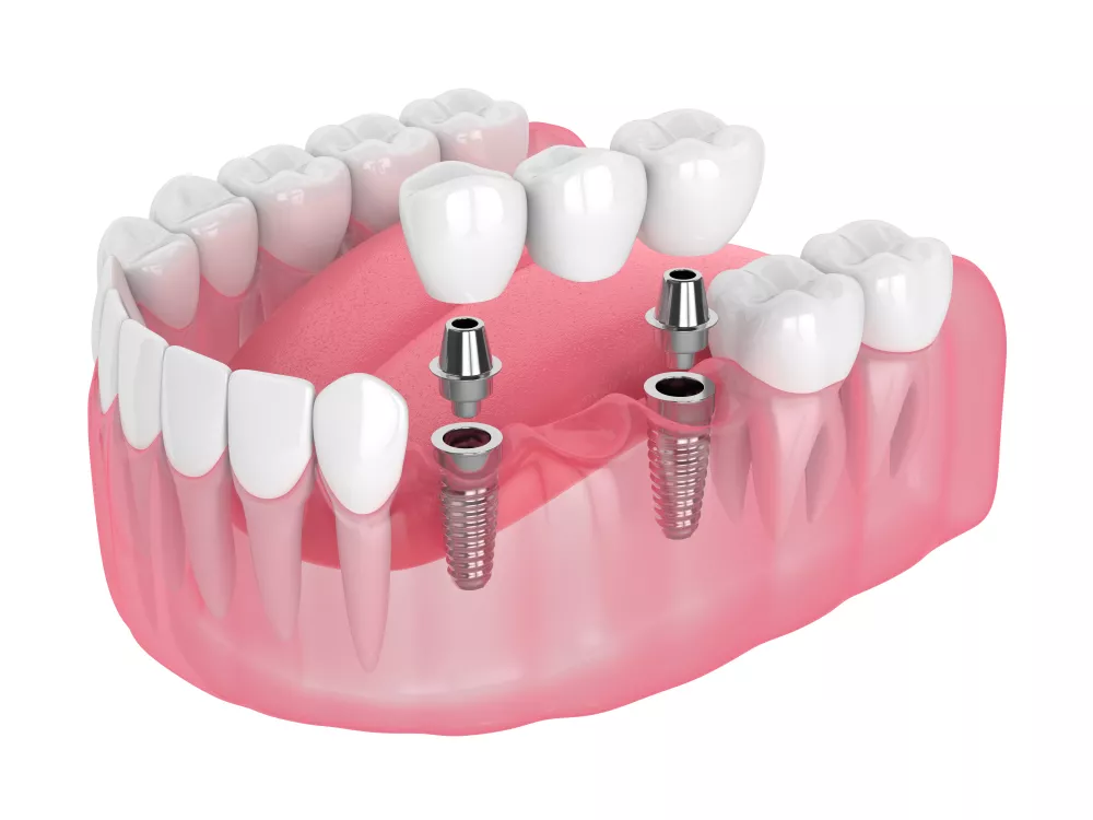 Guided Implant Placements 2 Tooth Implant