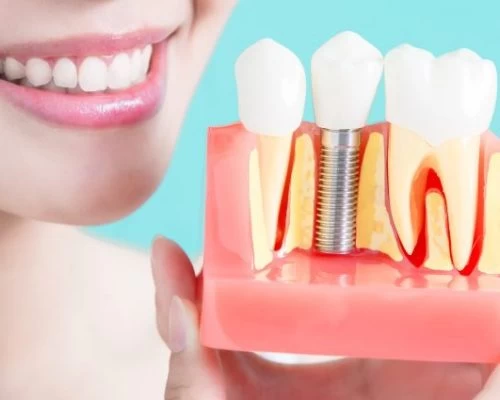 Guided Implant Placements 1 Tooth Implant