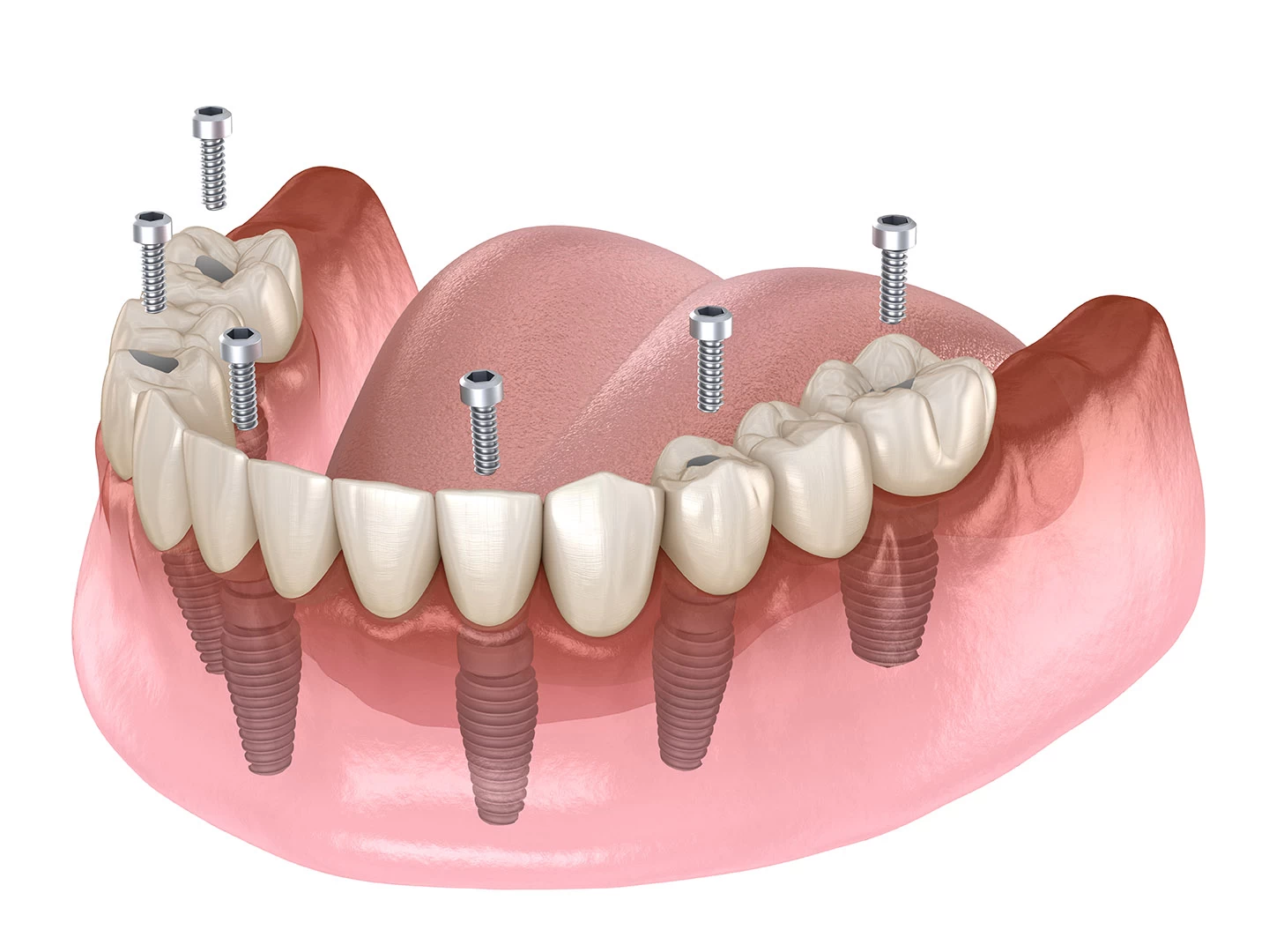 Mandibular,Prosthesis,All,On,4,System,Supported,By,Implants,,Screw Mandibular,Prosthesis,All,On,4,System,Supported,By,Implants,,Screw