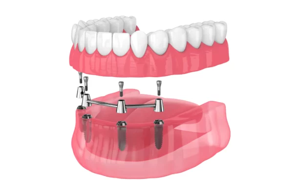 peak-dental-florida-All-On-4-Dental-Implants Teeth Whitening