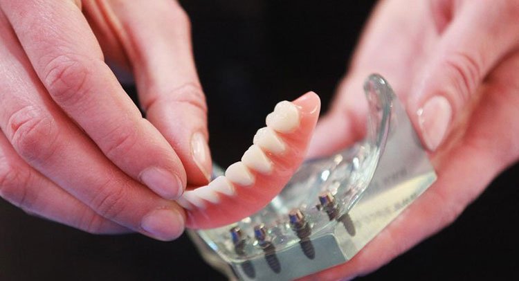 IMPLANT DENTURES WAUSAU