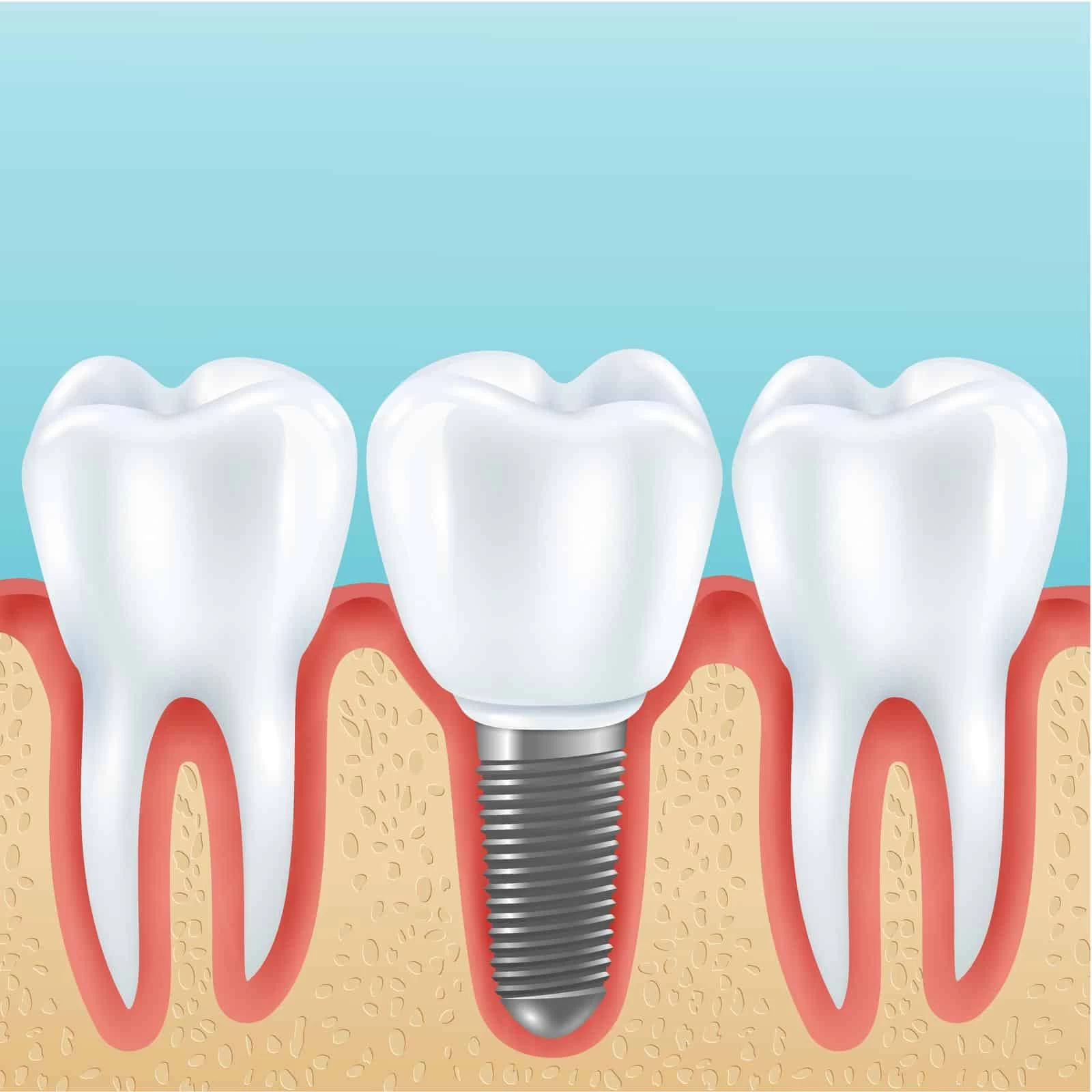 surgical 5 Replacing Teeth