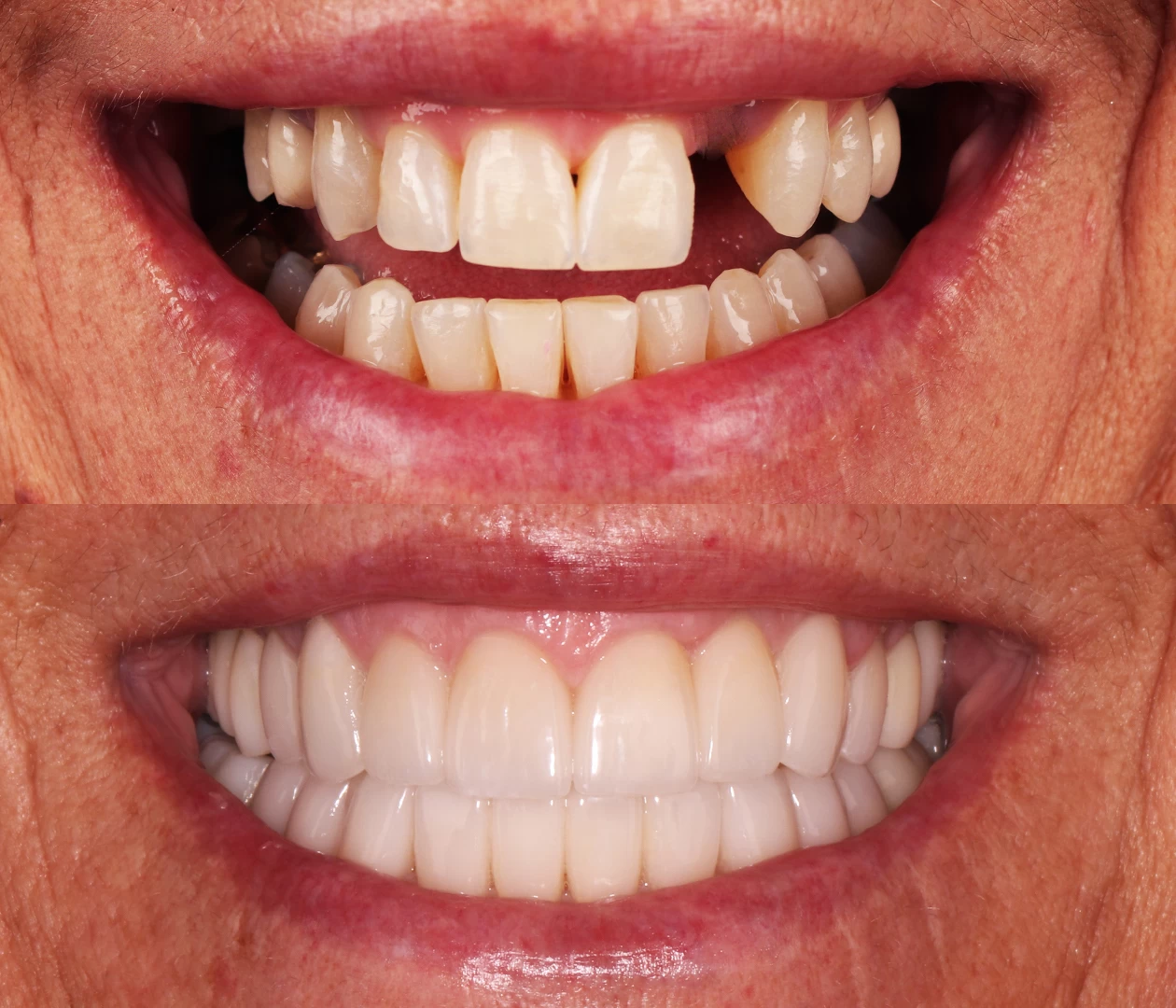 Anna Anderson BAS Teeth replacement in Wausau